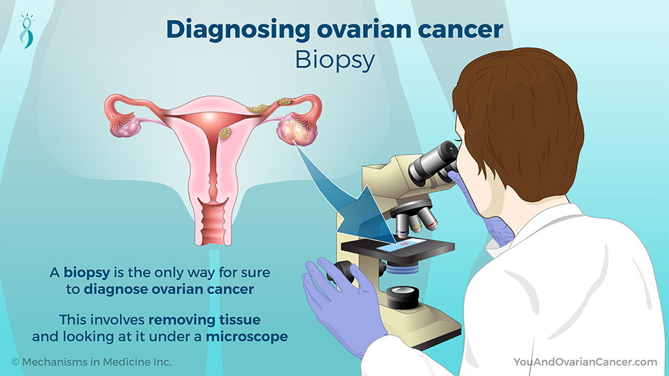 Diagnosing ovarian cancer - Biopsy