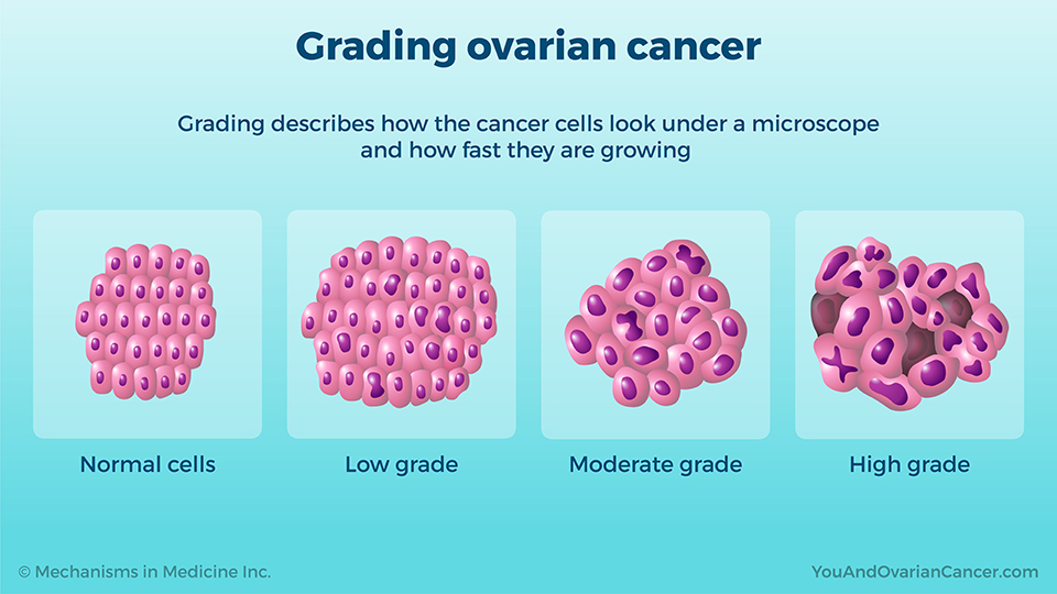 Grading ovarian cancer