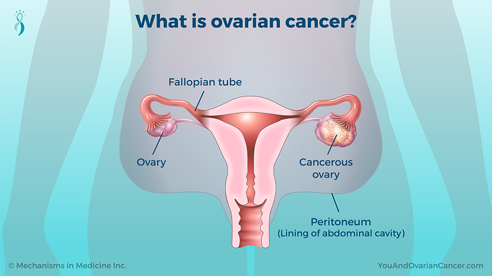 What is ovarian cancer?