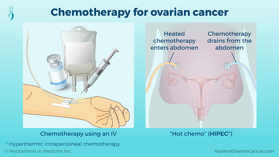 Chemotherapy for ovarian cancer