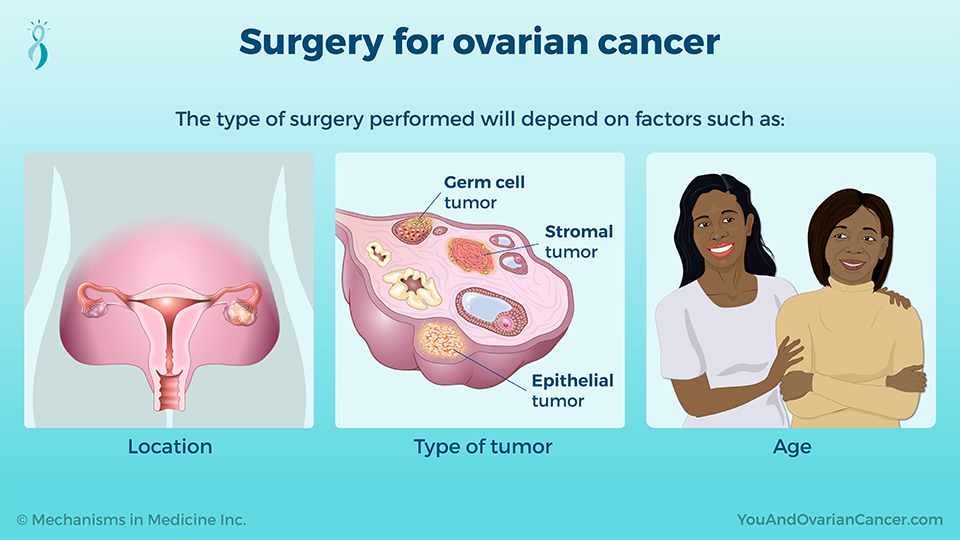 Surgery for ovarian cancer