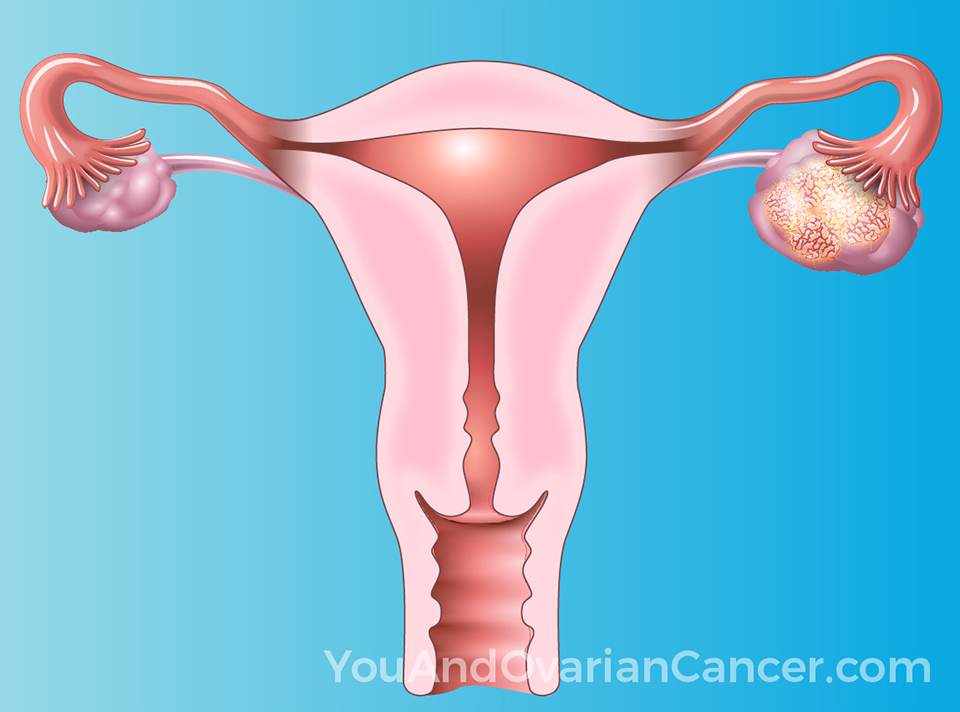 Learn about a variety of topics on ovarian cancer through short animations.