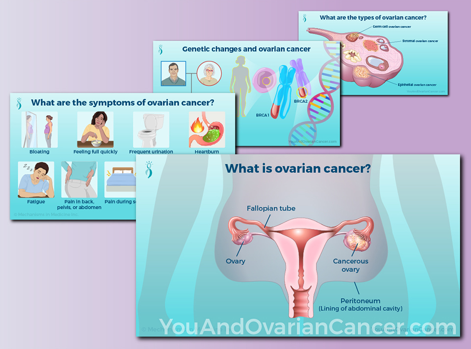 Access visuallly informative slide presentations on ovarian cancer