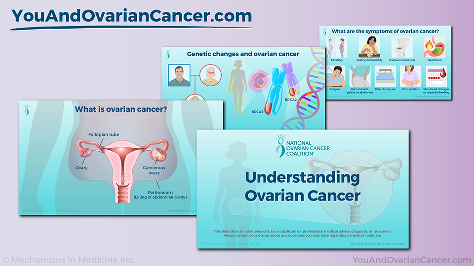 Slide Show - Understanding Ovarian Cancer