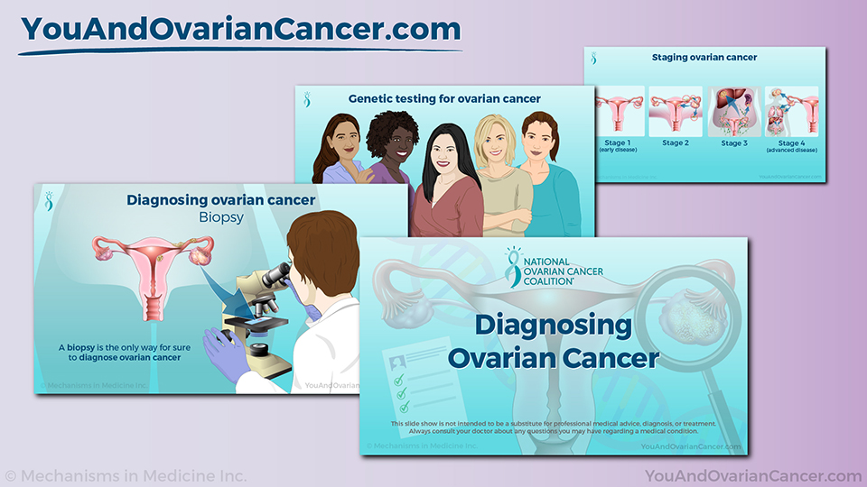 Slide Show - Diagnosing Ovarian Cancer
