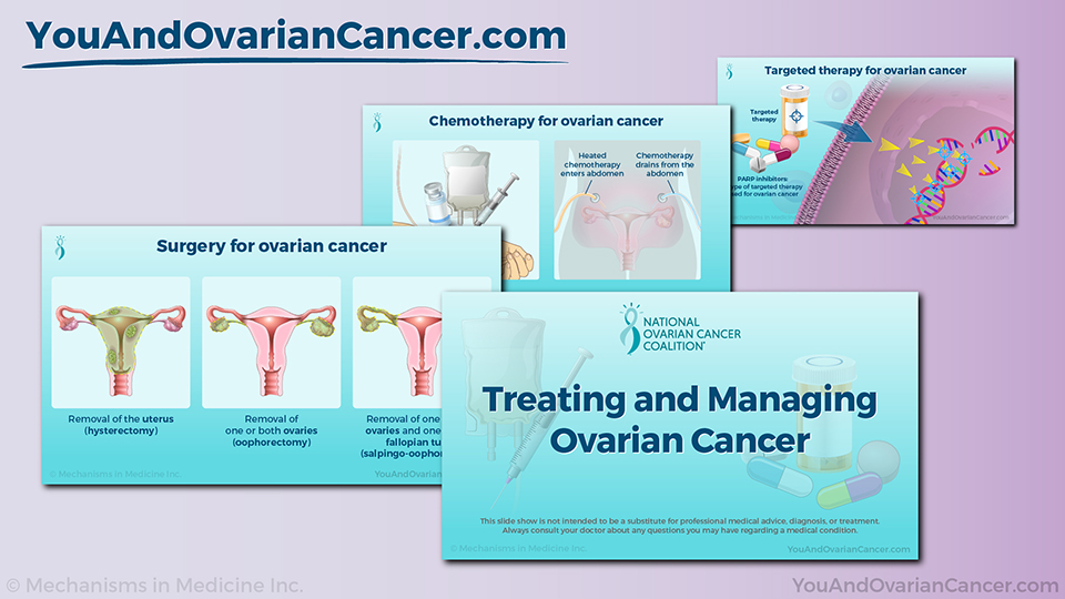 Treating and Managing Ovarian Cancer