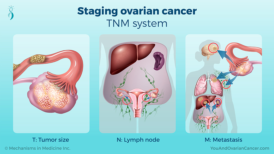 Staging ovarian cancer – TNM system