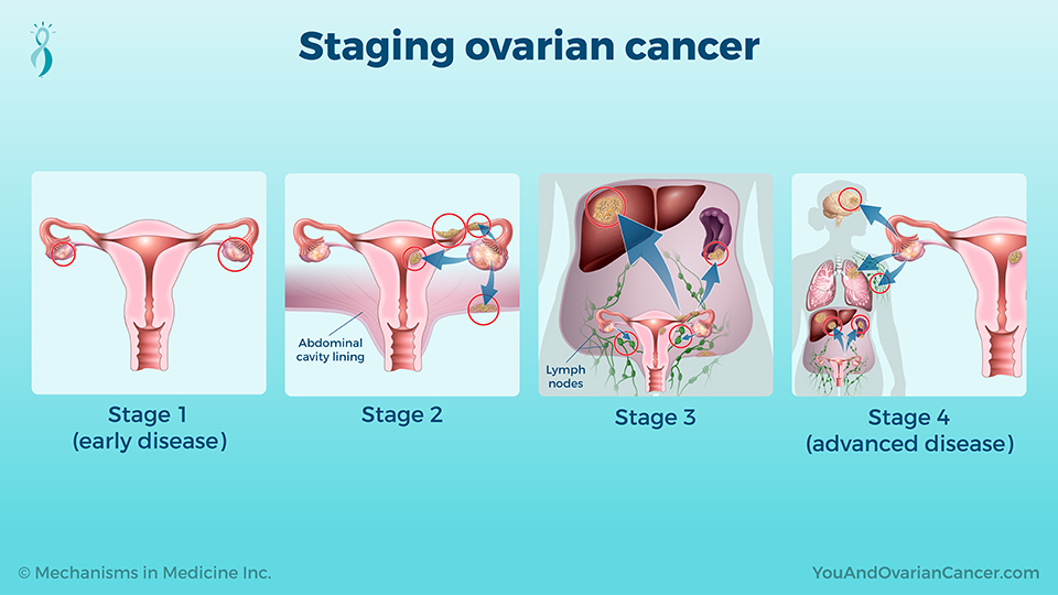 Staging ovarian cancer