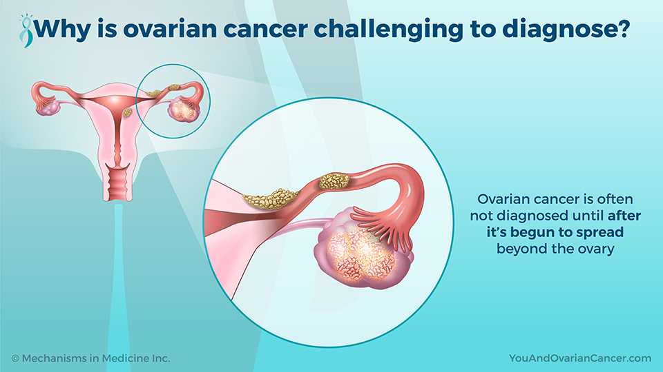 Why is ovarian cancer challenging to diagnose?