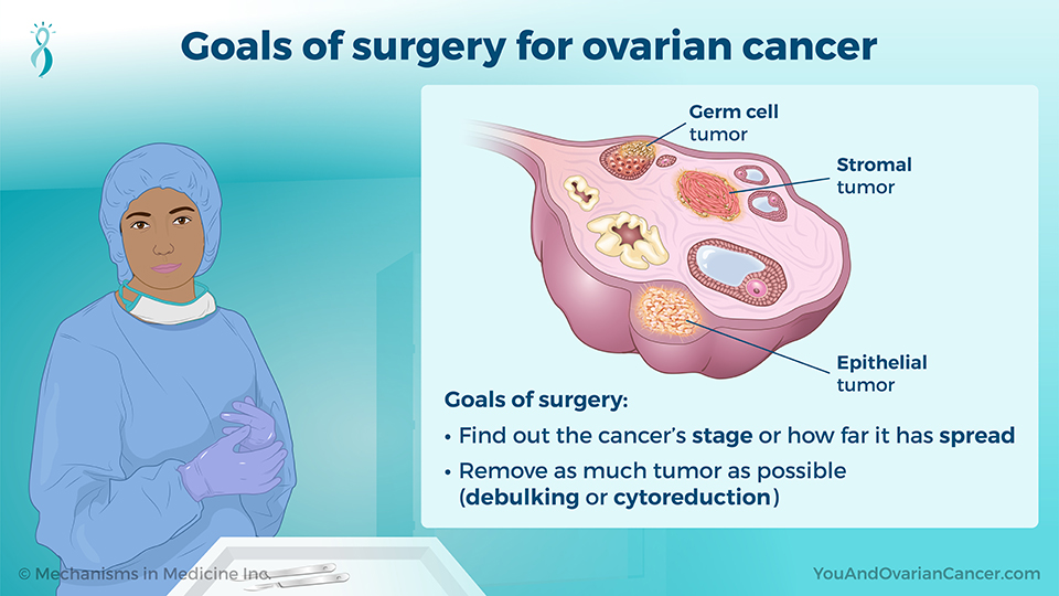 Goals of surgery for ovarian cancer