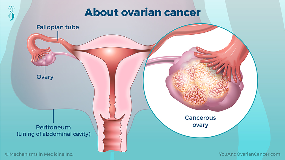 About ovarian cancer