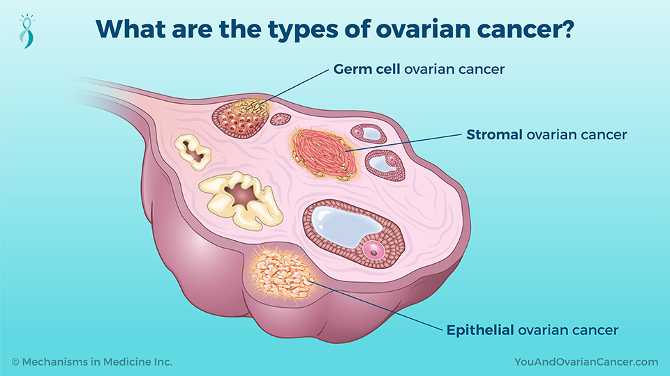 What are the types of ovarian cancer?