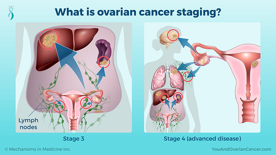 What is ovarian cancer staging?